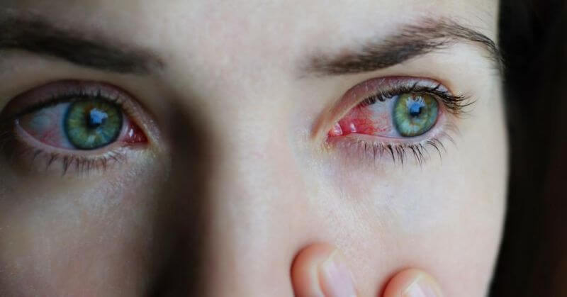 Conjunctivitis Causes And Symptoms
