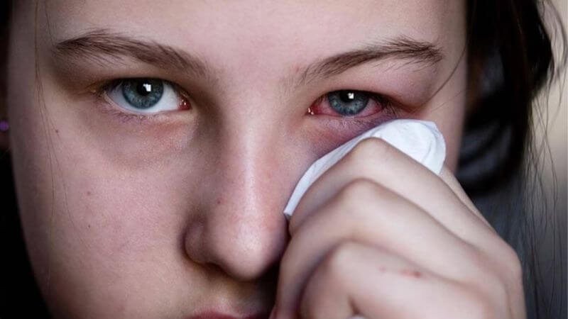 Conjunctivitis Infection