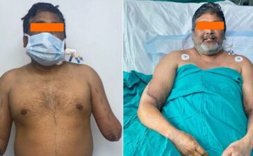 Delhi Painter Successful Hand Transplant