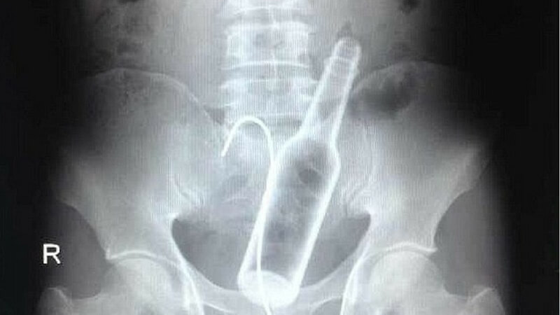 Coca-Cola Bottle Found on X-rays