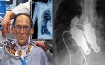 Craig Lewis, World's First Heartless Human