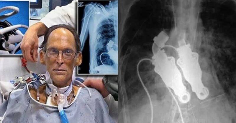 Craig Lewis, World's First Heartless Human