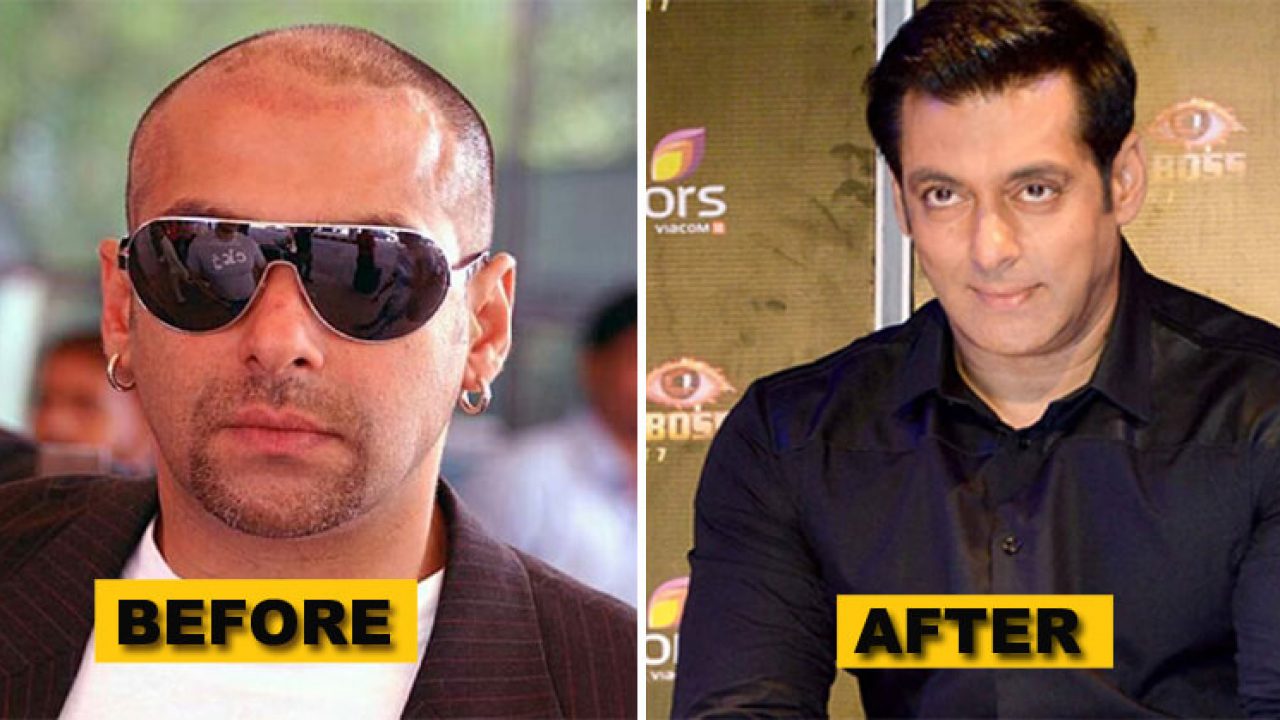 10 Bollywood Stars That Underwent The Hair Transplant Surgery