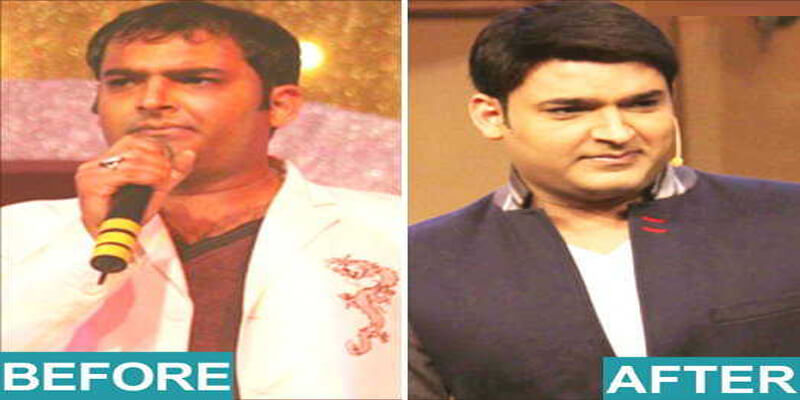 Bollywood Actor Adi Irani Hair Transplant Results  Medispa